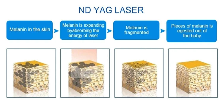 IPL OPT 3 In 1 Permanent Hair Removal E-light Epilator Nd Yag Laser Tattoo Removal RF Wrinkle Removal Whitening Facial Lift CE