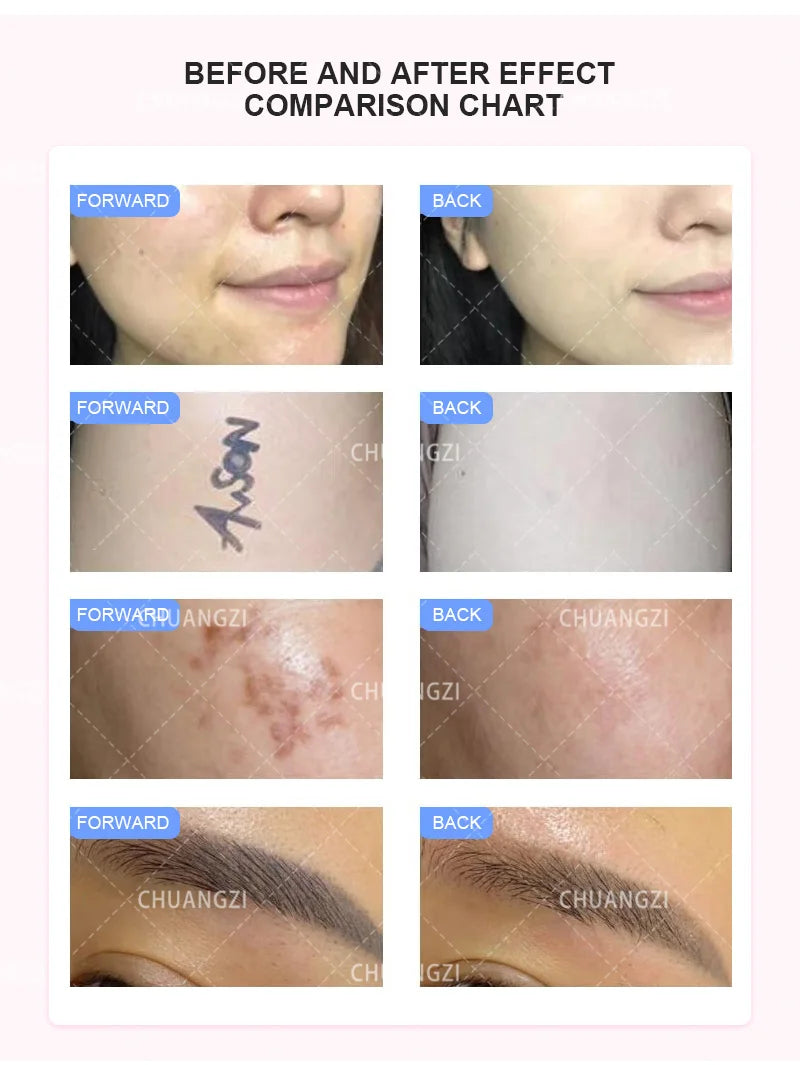 IPL OPT 3 In 1 Permanent Hair Removal E-light Epilator Nd Yag Laser Tattoo Removal RF Wrinkle Removal Whitening Facial Lift CE